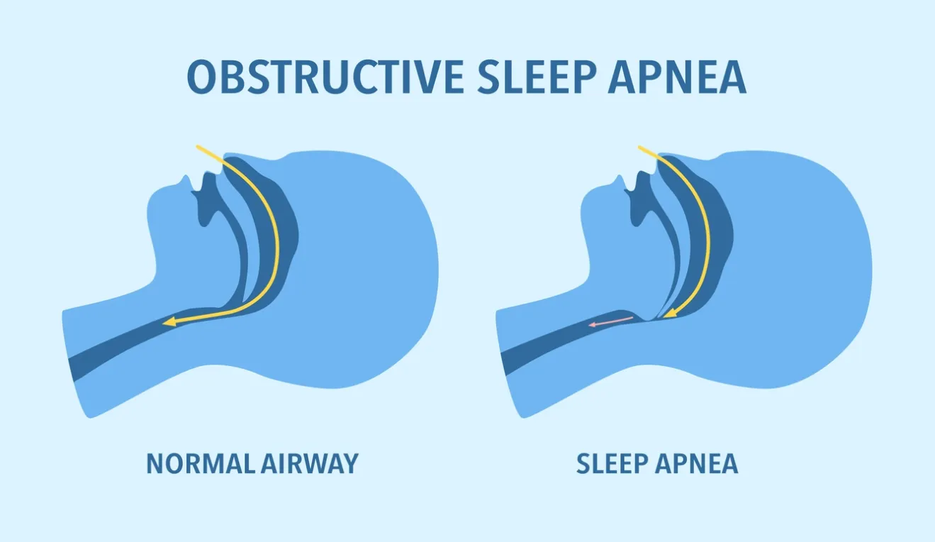 L'apnée du sommeil pourrait-elle vous affecter ?