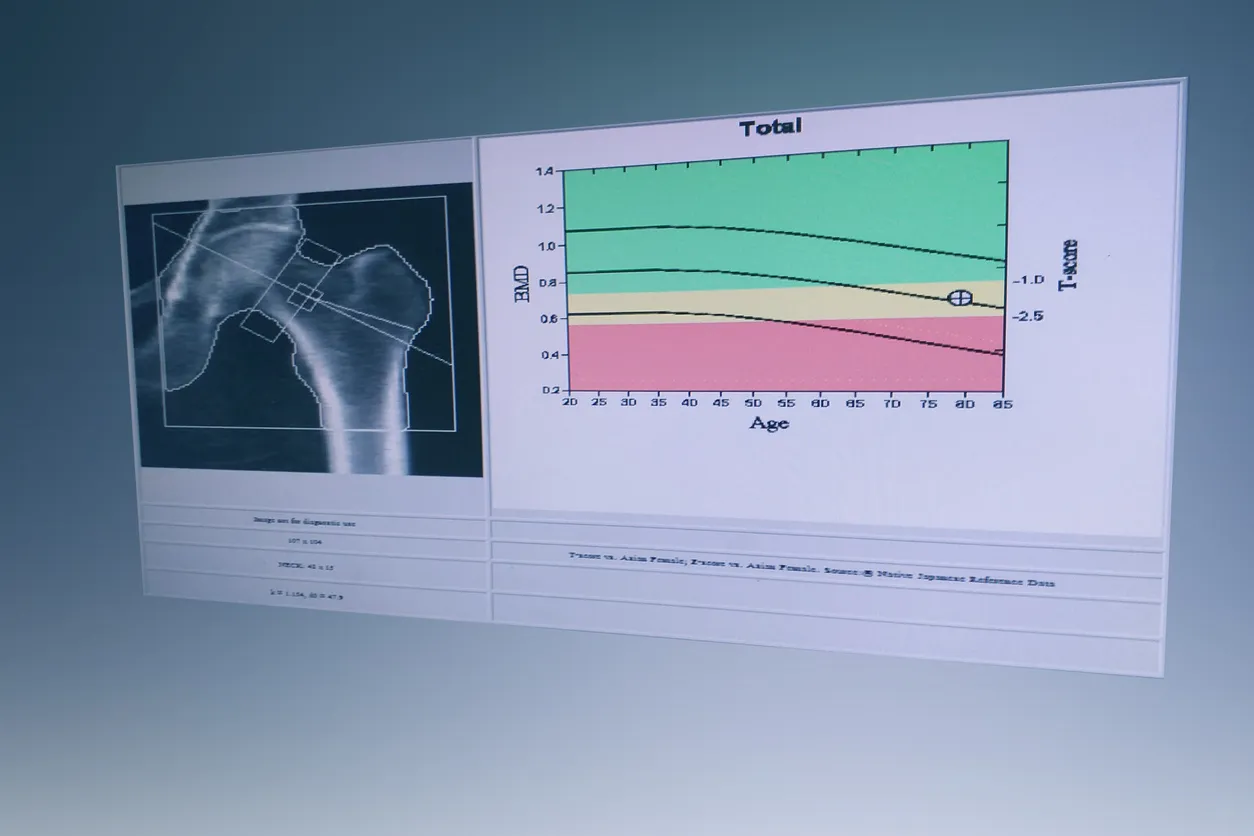 Résultat d’un examen de densité osseuse (DEXA) montrant une image de la hanche et un graphique de la densité minérale osseuse en fonction de l’âge.